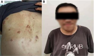 Case report: Surgical treatment of McCune-Albright syndrome with hyperthyroidism and retrosternal goiter: A case report and literature review